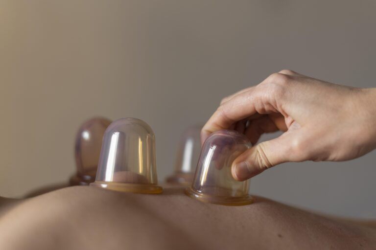 cups placed on body during dry cupping therapy